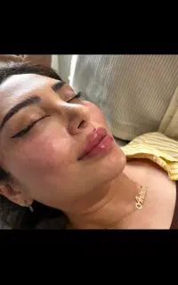 لیزر فیلر بادی ساکشن غبغب فیلر لب سوپرا