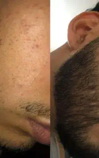 رشد بهتر ریش‌ها