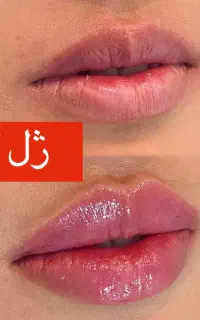 مطب ژل و بوتاکس ژل لب گرگان