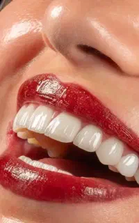 دندانپزشکی تبریز ایمپلنت  کامپوزیت عصبکشی  لمینیت