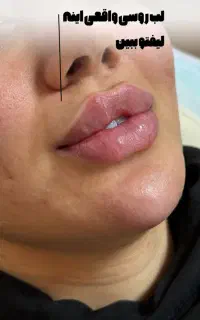 تزریق ژل بوتاکس فیلر لیزر فشیال مزو