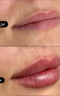فیلر ادری سی سی ۷۰۰،بوتاکس ۷۰۰، prp۷۰۰،سالسیژن ۷۰۰
