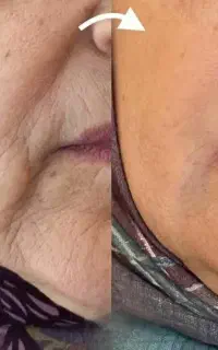 بوتاکس ولیفت طبیعی صورت باروغن تراپی