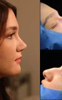 جراحی بینی،باروش نوین پیزو،تخفیف ۵۰درصد