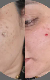 اولین مرکز تخصصی درمان زگیل تناسلی و واکسن