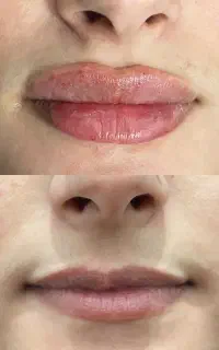 تزریق ژل و بوتاکس و کاشت ابرو