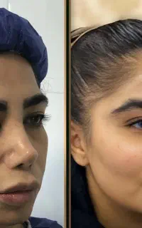 تزریق چربی صورت