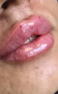 بوتاکس،ژل،مزوتراپی و خدمات زیبایی