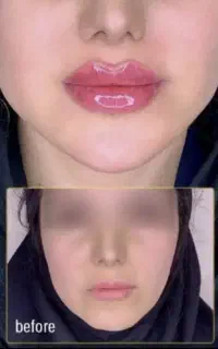 آف ژل و بوتاکس پک های مادلینگ