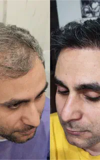 مرکز تخصصی کاشت مو و ابرو احمدیه  اژکان