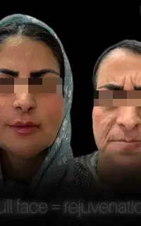 جشنواره طلایی ژل و بوتاکس و لیزربدن