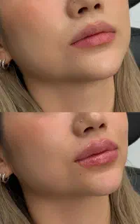 لیزر زیبایی ژل لب بوتاکس هایفو جوانسازی/تهرانپارس
