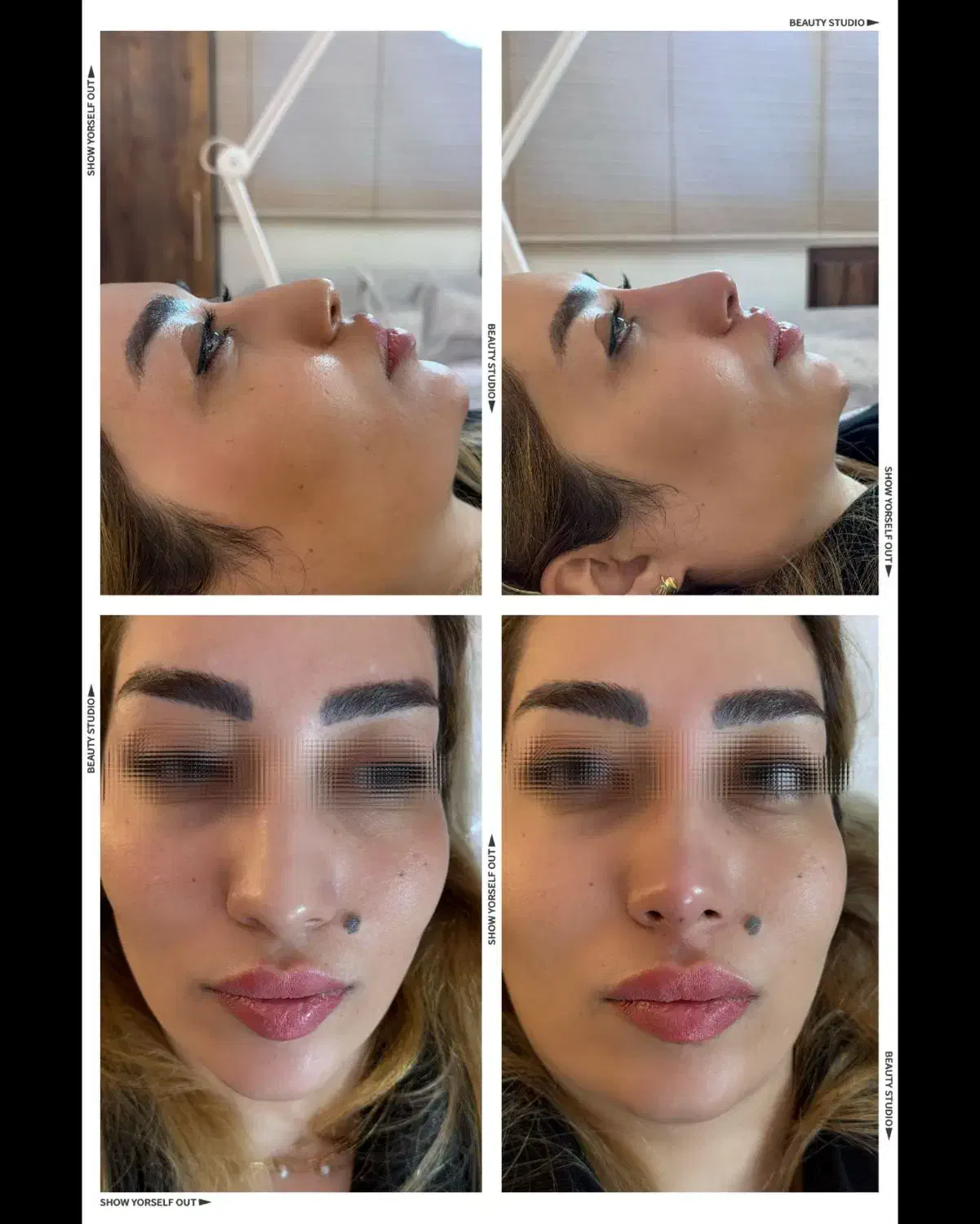 بوتاکس ژل لیفت نخ جراحی پلک چربی پی آرپی اندولیفت|خدمات زیبایی و سلامت|اصفهان, مولوی|دیوار
