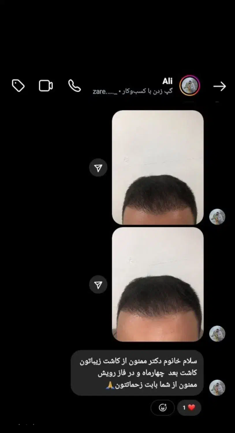 کاشت مو پرتراکم با تضمین کتبی نقد اقساط|خدمات آرایشگری و زیبایی|ساری, |دیوار