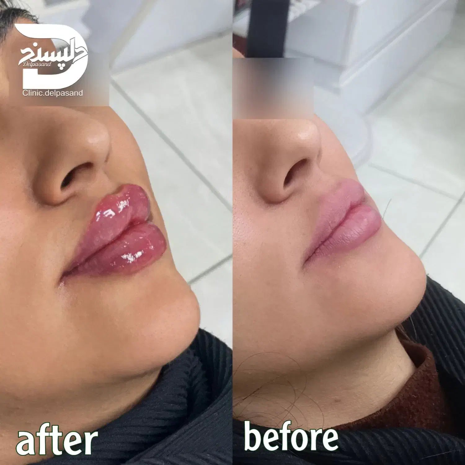 تزریق تخصصی ژل لب روسی و نچرال|خدمات آرایشگری و زیبایی|ارومیه, |دیوار