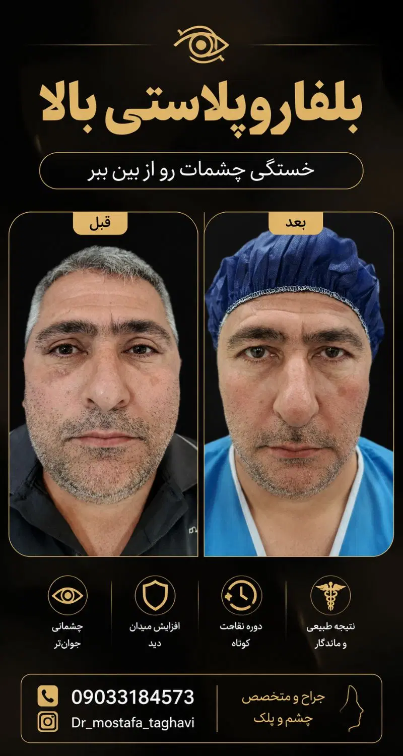 لیفت شقیقه . جراحی پلک بلفاروپلاستی|خدمات زیبایی و سلامت|ساری, |دیوار