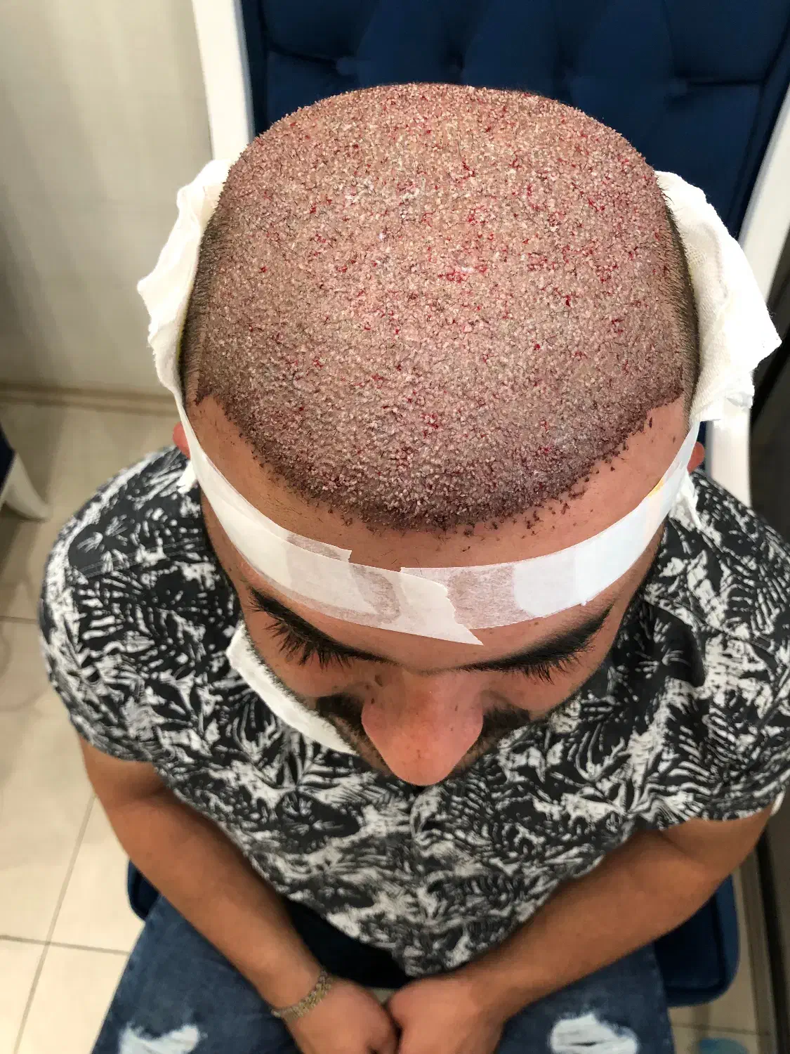 کاشت مو|خدمات آرایشگری و زیبایی|شیراز, قصرالدشت|دیوار