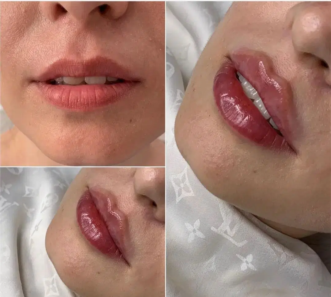 افر استثنایی فیلر بادی،بوتاکس،کانتورینگ،ژل مزوژل|خدمات آرایشگری و زیبایی|تهران, تهرانسر مرکزی|دیوار