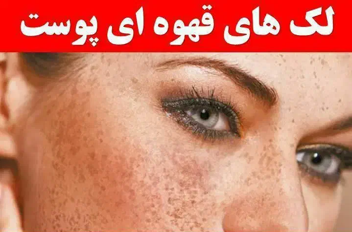 لک قهویی|آرایشی، بهداشتی، درمانی|هشتگرد, مدرس|دیوار