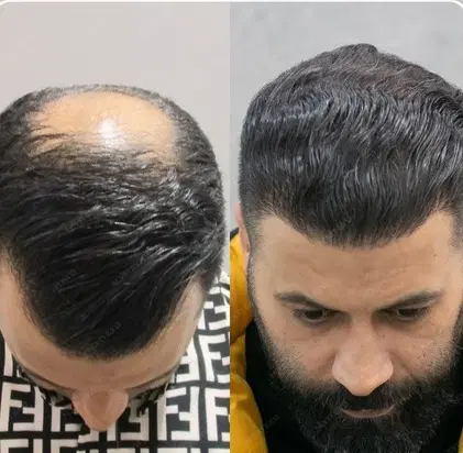 کاشت مو|خدمات آرایشگری و زیبایی|شهریار, شهریار|دیوار