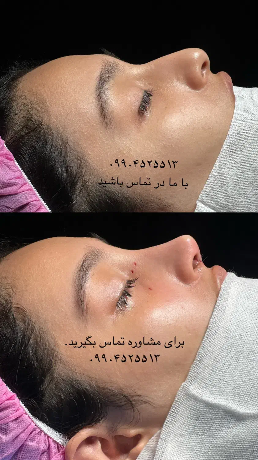عمل بینی/تمدید تخفیف اخرماه/با پیزو/بدون تامپون/۳۵|خدمات آرایشگری و زیبایی|تهران, دزاشیب|دیوار