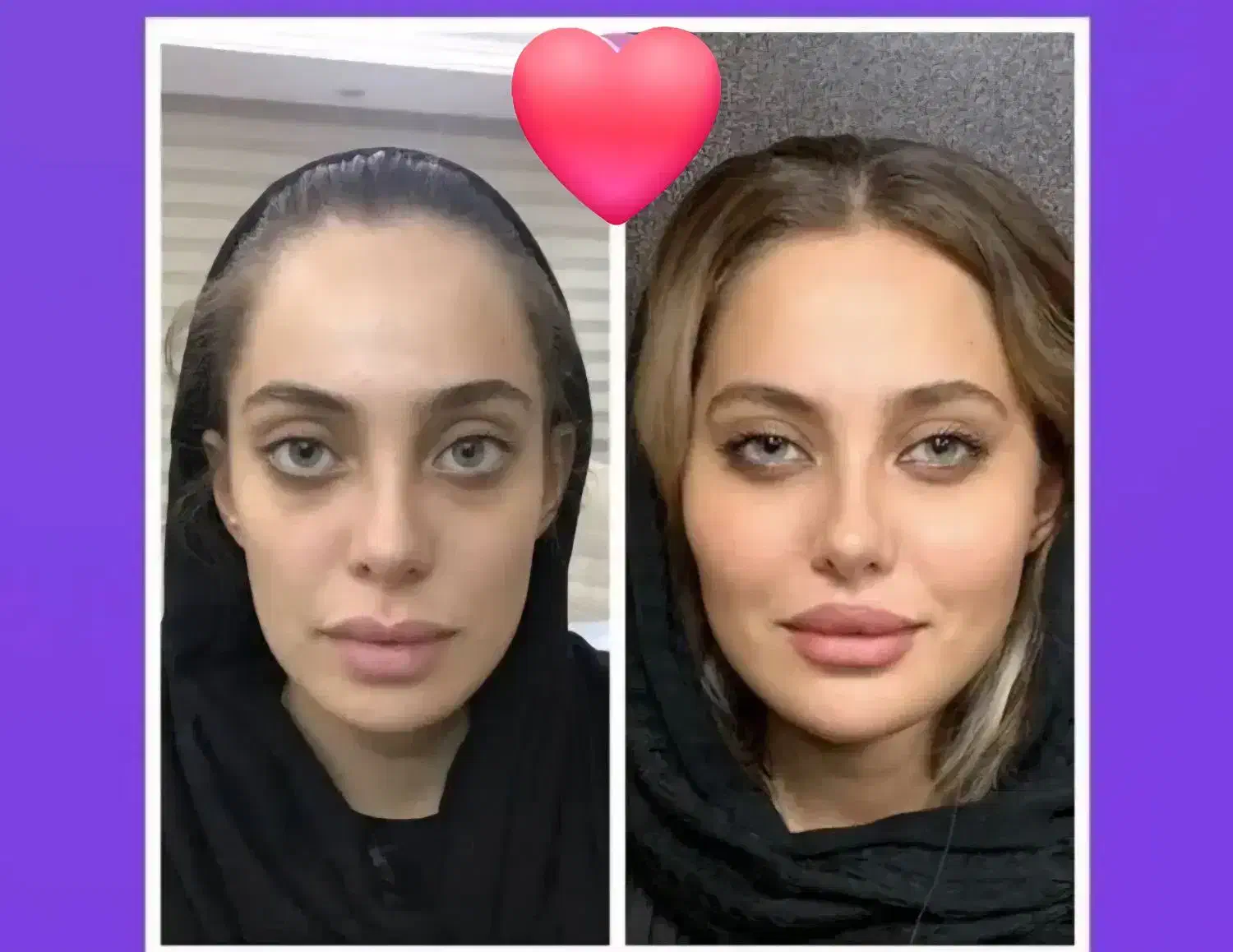 آفر ویژه خدمات زیبایی بوتاکس فیلرو.. کلینیک پزشکی|خدمات آرایشگری و زیبایی|کرج, جهانشهر|دیوار