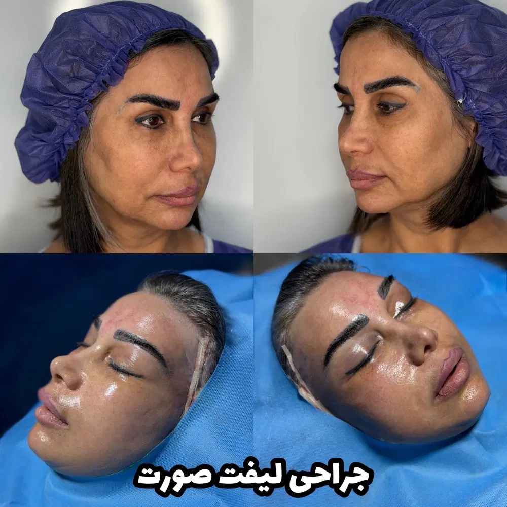 لیفت شقیقه . جراحی پلک بلفاروپلاستی|خدمات زیبایی و سلامت|ساری, |دیوار