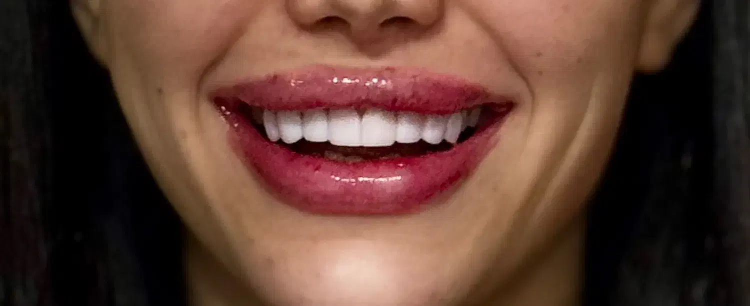 کامپوزیت و کاشت دندان با بهترین متریال و قیمت|خدمات آرایشگری و زیبایی|ساری, |دیوار