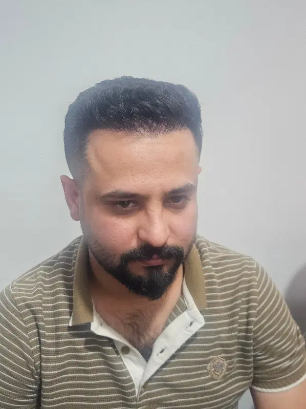 کاشت مو|خدمات آرایشگری و زیبایی|بندرعباس, |دیوار