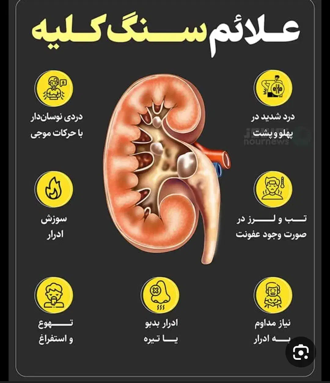 درمان کاملا گیاهی سنگ کلیه و کلیه سنگ ساز|خدمات آرایشگری و زیبایی|ساری, |دیوار
