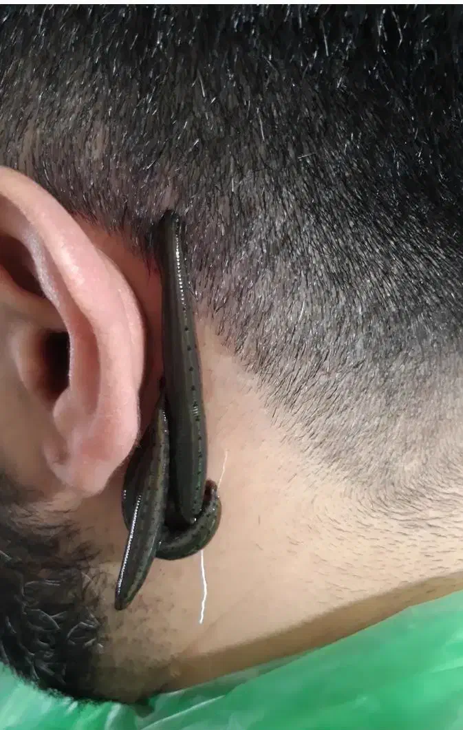 حجامت،فصدخون،زالو درمانی،طب سنتی،پی آر پی|خدمات آرایشگری و زیبایی|تهران, تهرانسر شمالی|دیوار