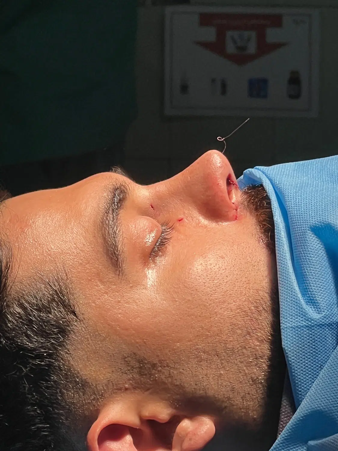 عمل بینی..|خدمات آرایشگری و زیبایی|آمل, |دیوار