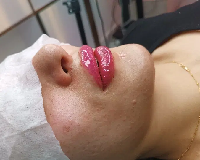 افر استثنایی فیلر بادی،بوتاکس،کانتورینگ،ژل مزوژل|خدمات آرایشگری و زیبایی|تهران, تهرانسر مرکزی|دیوار