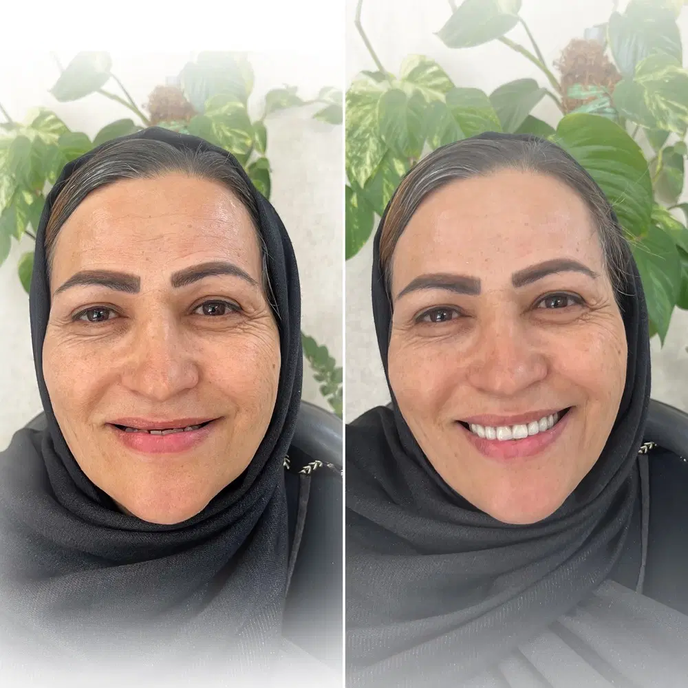 دندان مصنوعی و دندانسازی طرح لمینت اقساطی|خدمات آرایشگری و زیبایی|مشهد, عامل|دیوار