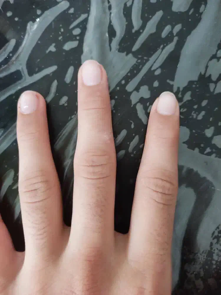 حذف زگیل تناسلی به صورت ریشه ای|خدمات آرایشگری و زیبایی|آمل, |دیوار