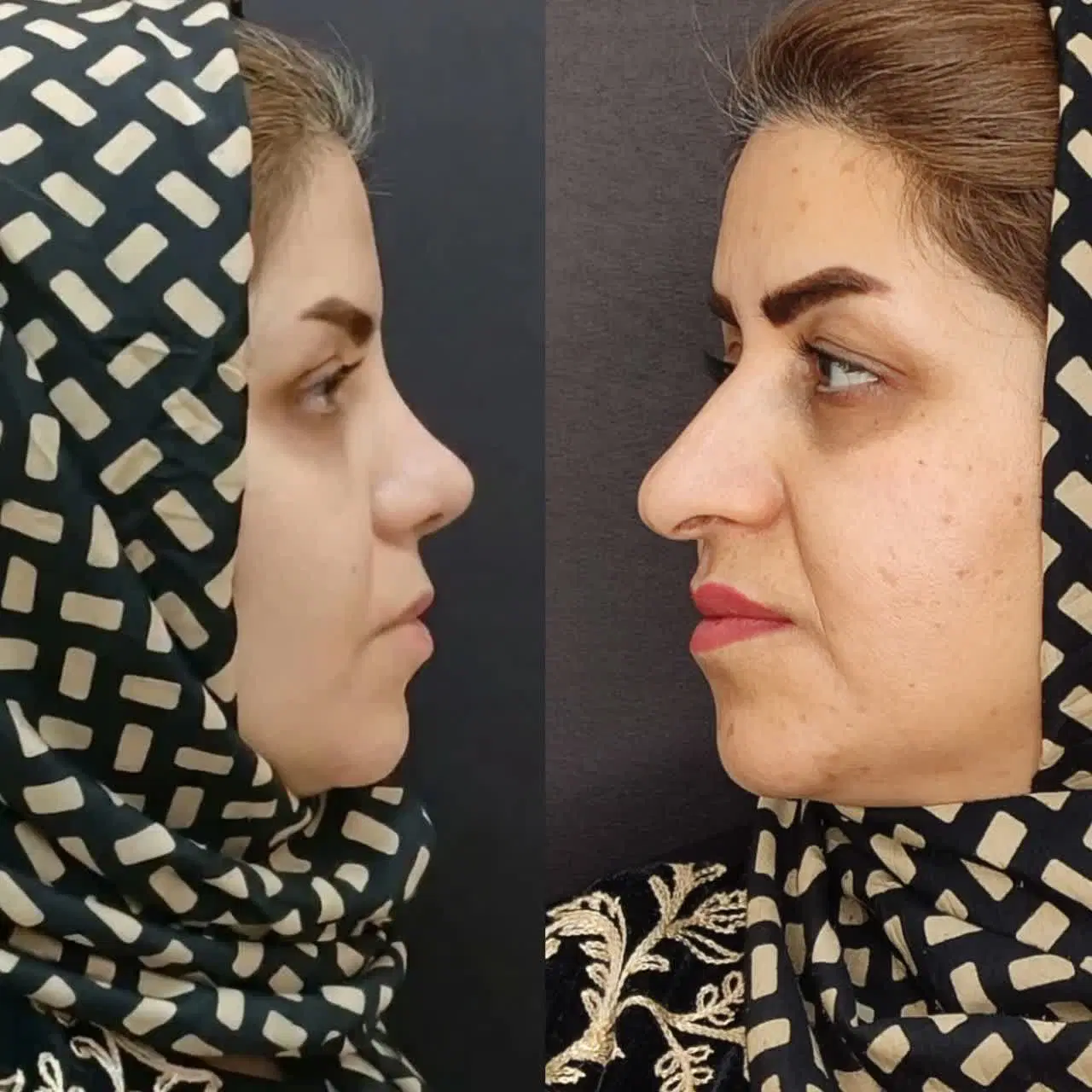 جراحی بینی،پلک(اقساطی)|خدمات آرایشگری و زیبایی|یزد, |دیوار