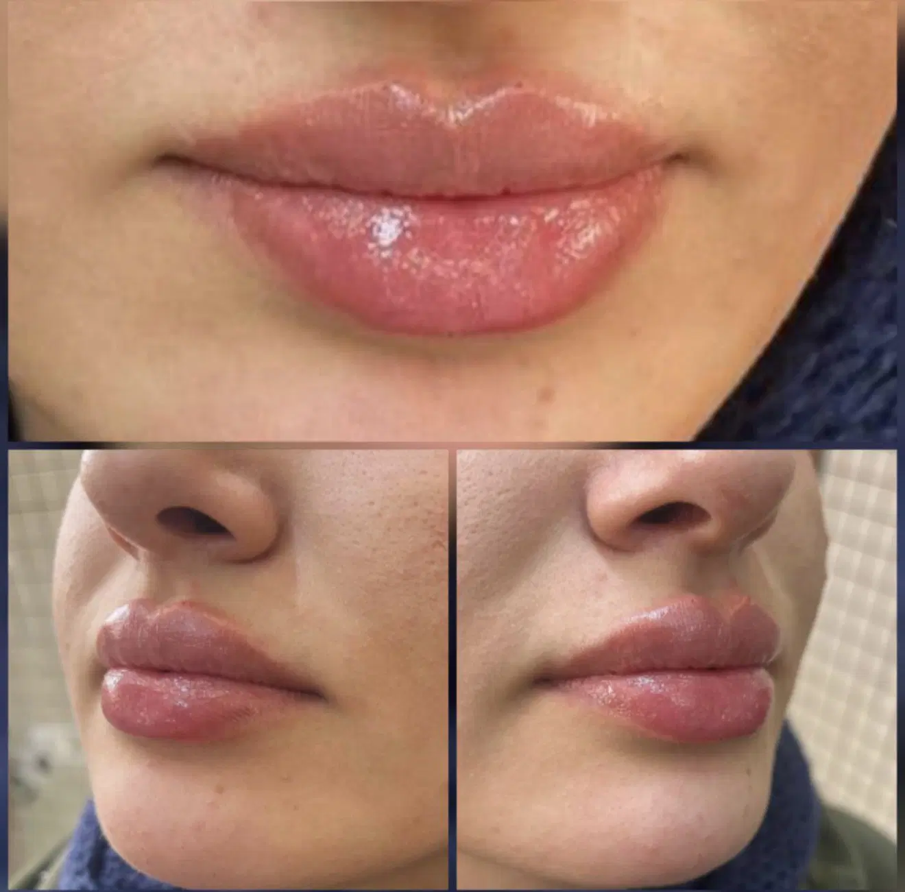 جشنواره ویژه تزریق ژل و مزو و پی آرپی درمطب|خدمات زیبایی و سلامت|اصفهان, نقش جهان|دیوار