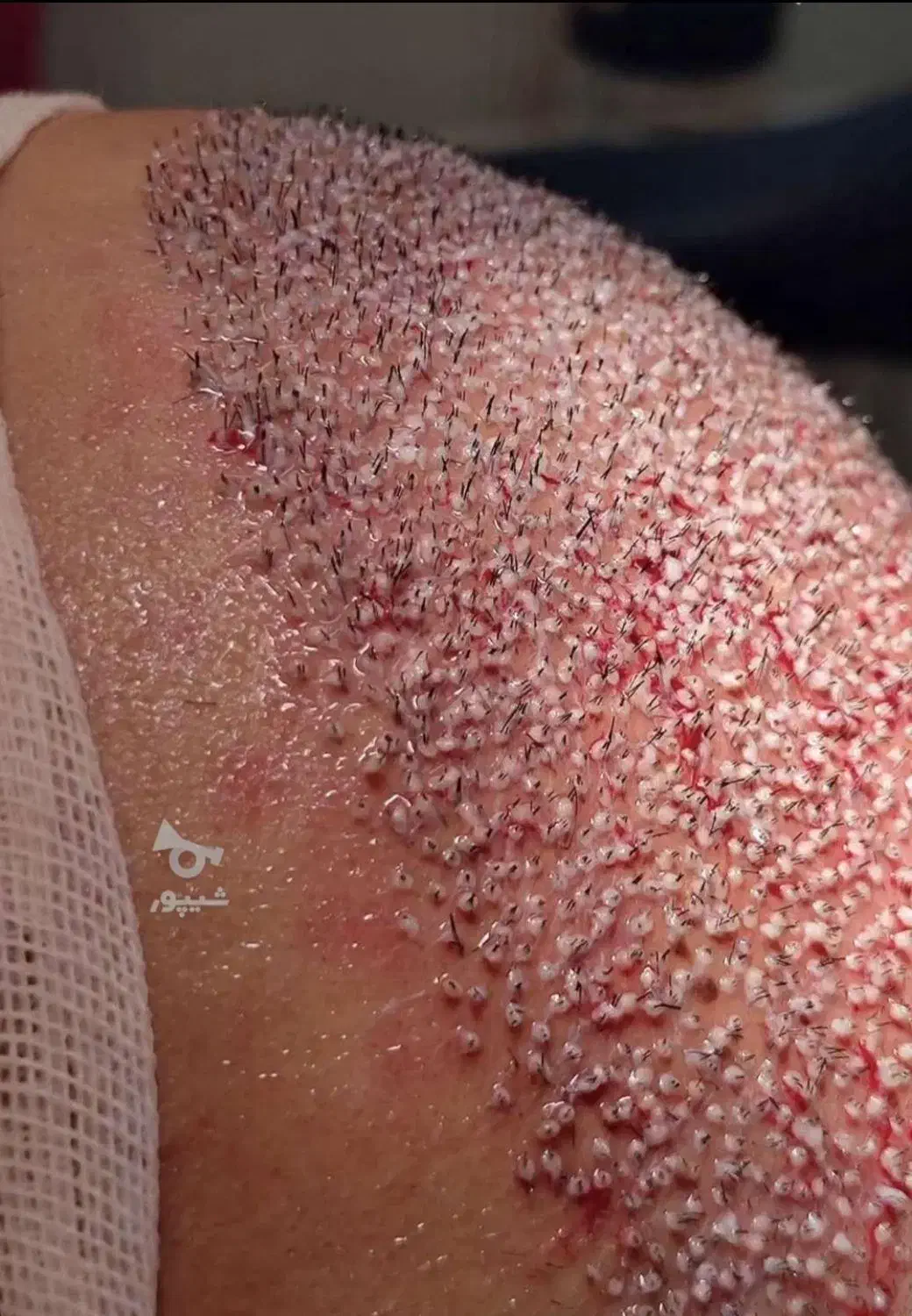 کاشت مو پرتراکم با تضمین کتبی نقد اقساط|خدمات آرایشگری و زیبایی|ساری, |دیوار