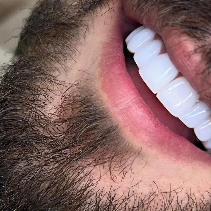 دندان مصنوعی و دندانسازی طرح لمینت اقساطی|خدمات آرایشگری و زیبایی|مشهد, عامل|دیوار