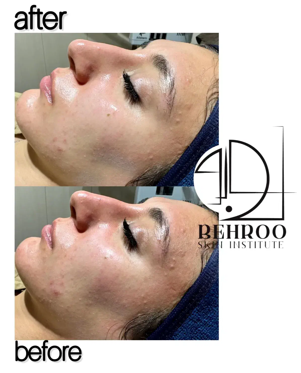 پاکسازی و فیشال صورت و اسکالپ|خدمات آرایشگری و زیبایی|تاکستان, |دیوار