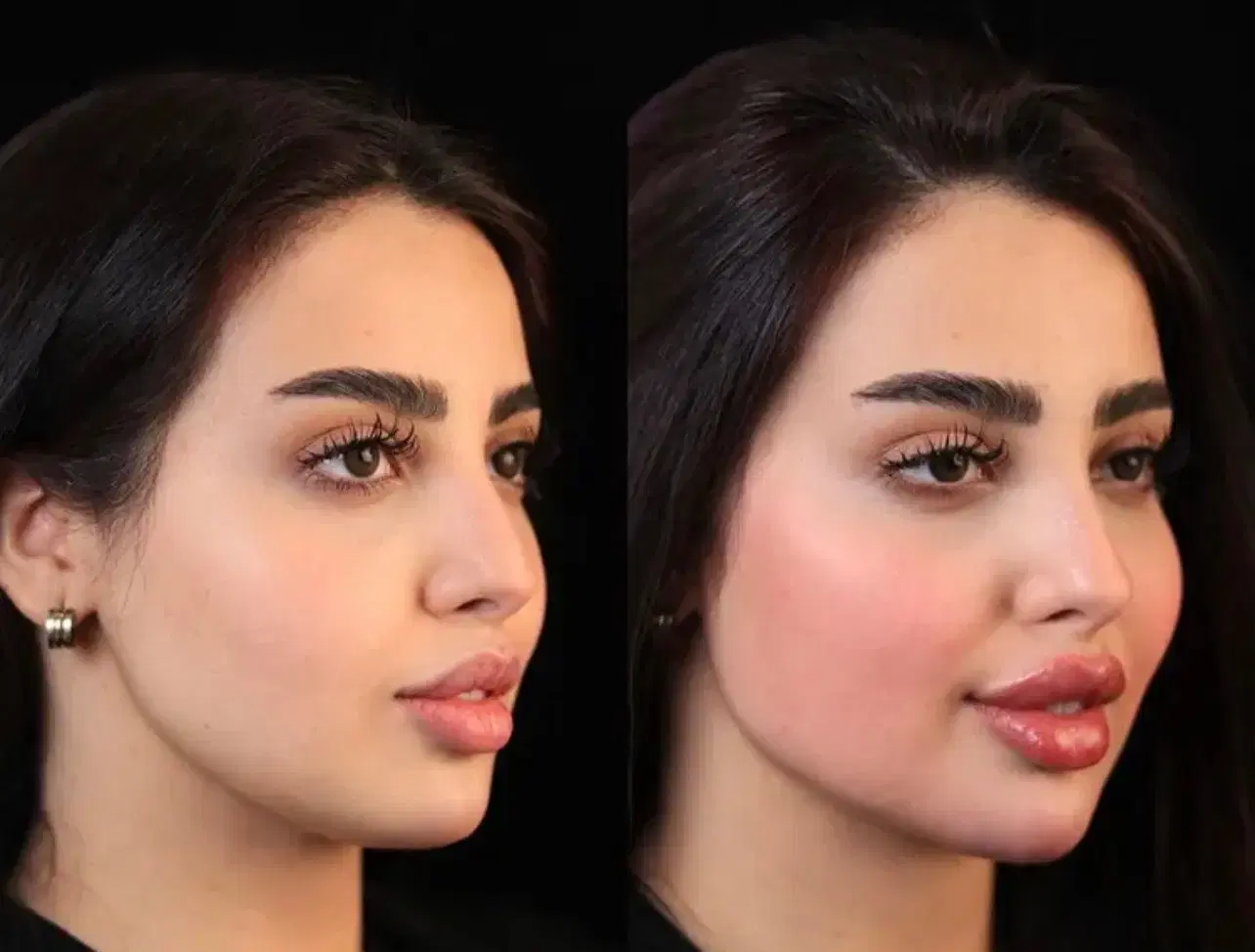 فیلرلب،ژل،چونه،پی ارپی،جوانساز|خدمات زیبایی و سلامت|کرج, جهان‌شهر|دیوار