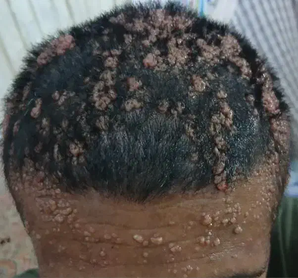 درمان زگیل|خدمات آرایشگری و زیبایی|ساری, |دیوار