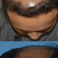 کاشت مو نکنین پیش ثنا نوذری
