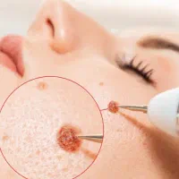 لیزر زگیل hpv.خال،میخچه.لیزر تتو ،پیرسینگ در محل