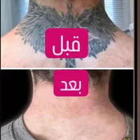 مرکز ریمو،پاک کردن،ریموو تتوابرو.بدن.خط چشم بالیزر