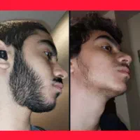 فولیکوژن‌تراپی + مکمل‌تراپی