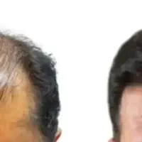 کاشت مو 20 میلیون تومان برای 10 نفر