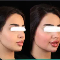مدل تزریقات زیبایی (تزریق توسط پزشک مجرب زیبایی )