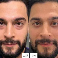 بلفاروپلاستی پلک بدون جراحی(جشنواره/فرصت نامحدود)