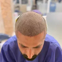 کاشت تخصصی مو از شیراز در شهر کاشان